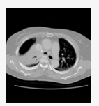 Chest CT