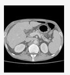 Abdomen CT