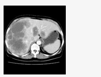 Liver CT